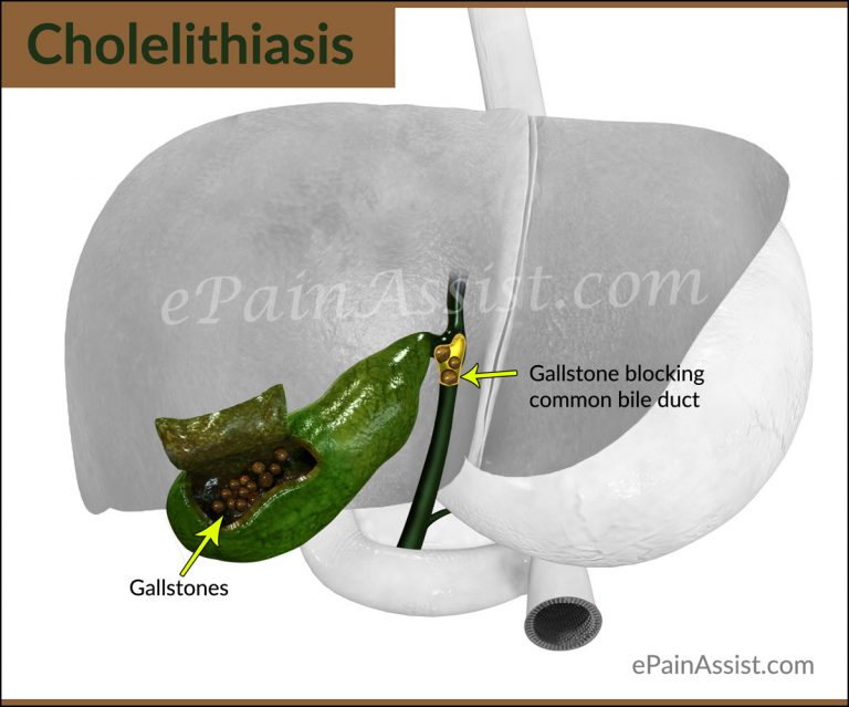 Cholelithiasis: Classification & Types, Causes, Risk Factors, Signs, Symptoms, Tests, Treatment