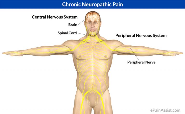 Chronic Neuropathic Pain: Causes, Symptoms, Treatment- Manual Focused Therapy, Surgery