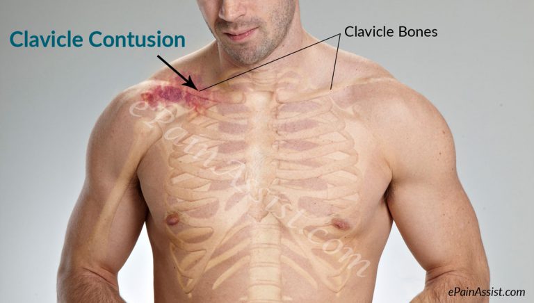 Bruised Collarbone Or Clavicle Contusion: Causes, Symptoms, Diagnosis, Treatment