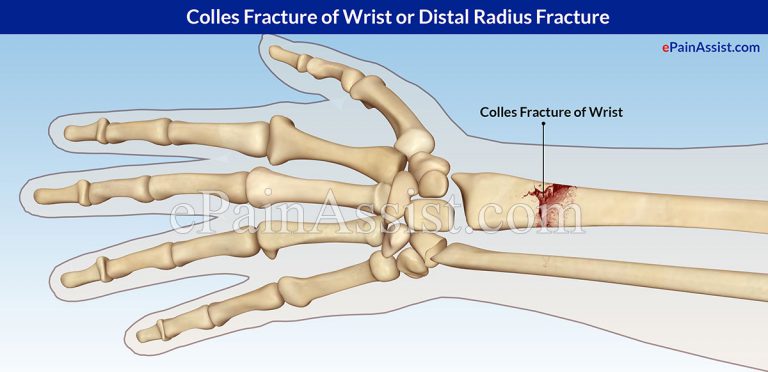 Colles Fracture of Wrist or Distal Radius Fracture: Causes, Symptoms, Treatment