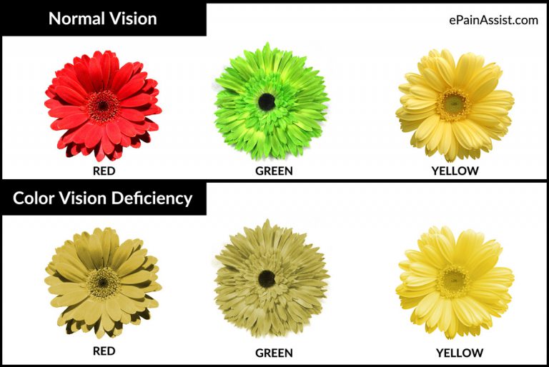 Color Blindness or Color Vision Deficiency: Causes, Symptoms, Tests, Treatment