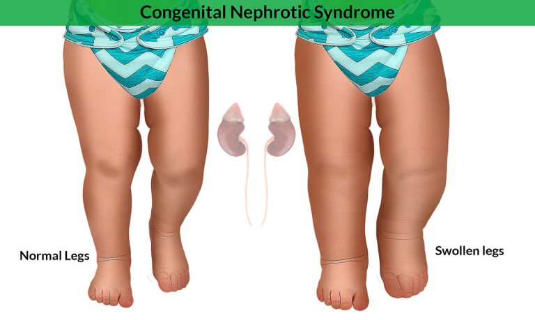 Congenital Nephrotic Syndrome: Causes, Systemic Effects, Symptoms, Diagnosis, Treatment