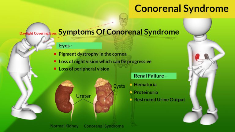 Conorenal Syndrome or Mainzer-Saldino Syndrome: Causes, Symptoms, Diagnosis, Treatment