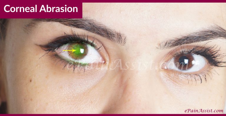 Corneal Abrasion: Causes, Symptoms, Treatment- Antibiotic Eye Drops, Pain Killers