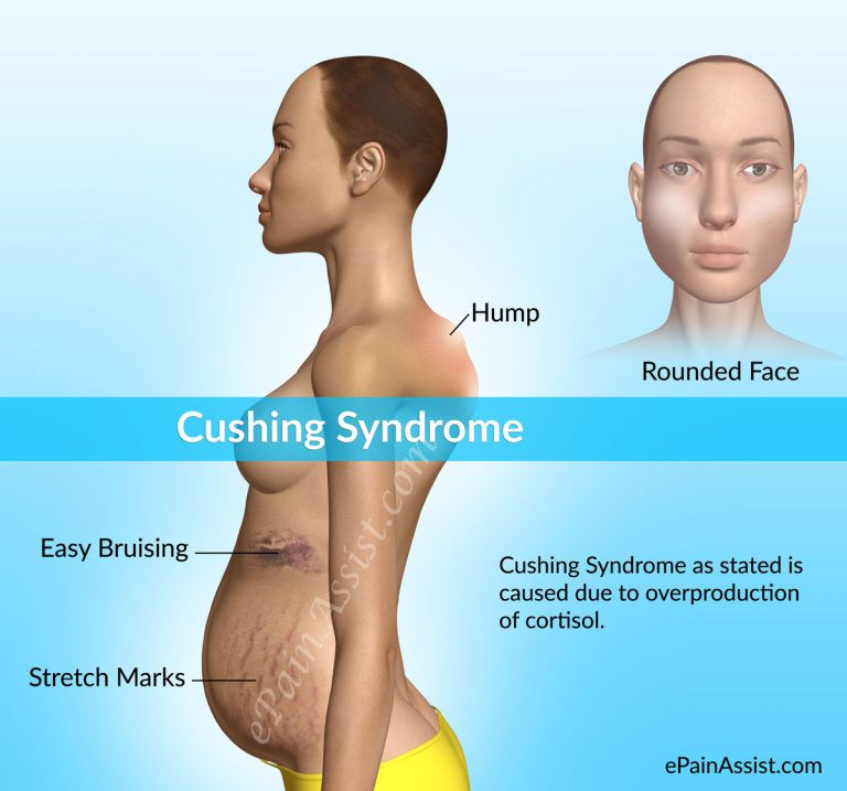 Cushing Syndrome : Causes, Symptoms, Diagnosis, Treatment, Home Remedies