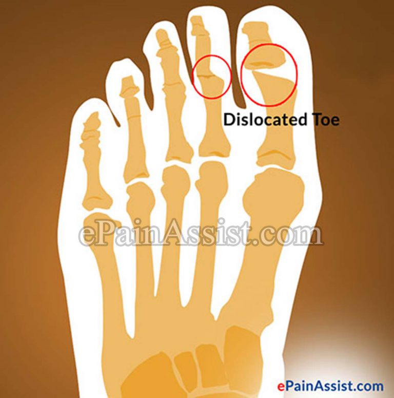 Dislocated Toe: Signs, Symptoms, Treatment- RICE, Buddy Tape, Strapping, Whirlpool