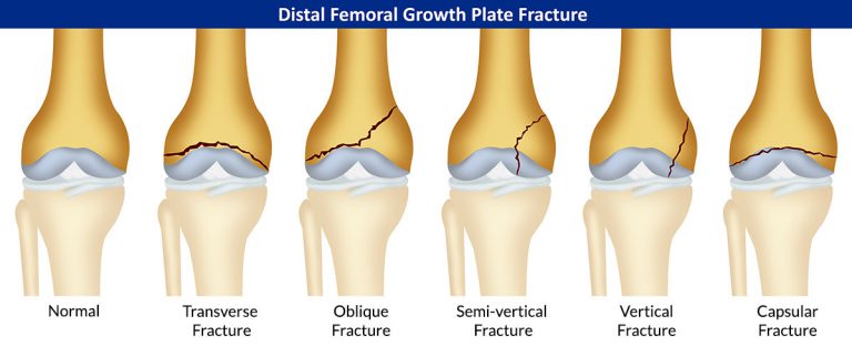 Distal Femoral Growth Plate Fracture: Symptoms, Causes, Treatment-Casting, Surgery