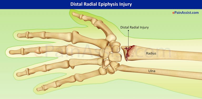 Distal Radial Epiphysis Injury: Causes, Symptoms, Treatment- Surgery, PT, Exercises