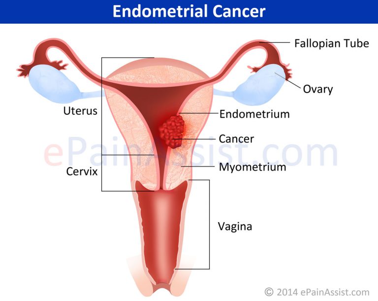 Endometrial Cancer or Uterine Cancer: Symptoms, Treatment- Radiation, Hormone Therapy
