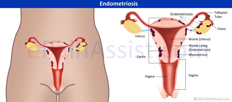 Endometriosis: Causes, Signs, Symptoms, Treatment