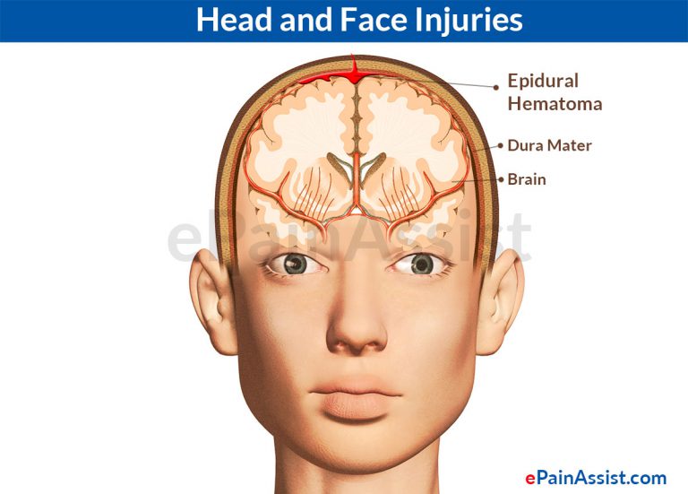 Epidural or Extradural Hematoma: Causes, Signs- Dizziness, Pupil Dilation, Treatment