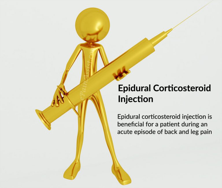Epidural Corticosteroid Injection: A Treatment Choice for Back Pain