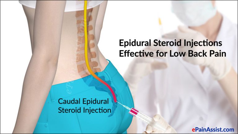 News: Study Suggests Epidural Steroid Injections Effective for Low Back Pain