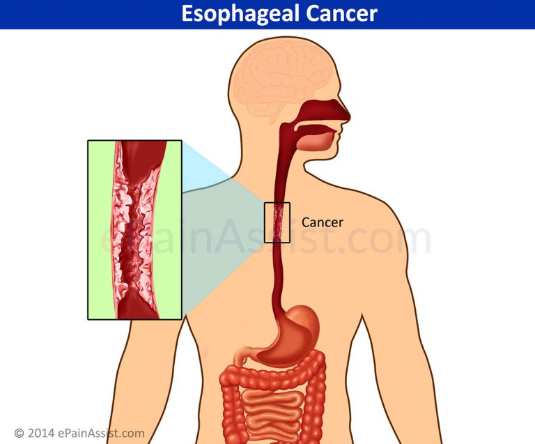 Esophageal Cancer: Causes, Types, Symptoms, Stages, Treatment