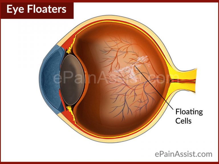 Eye Floaters : What Causes Floaters in Eye and How to Get Rid of it?