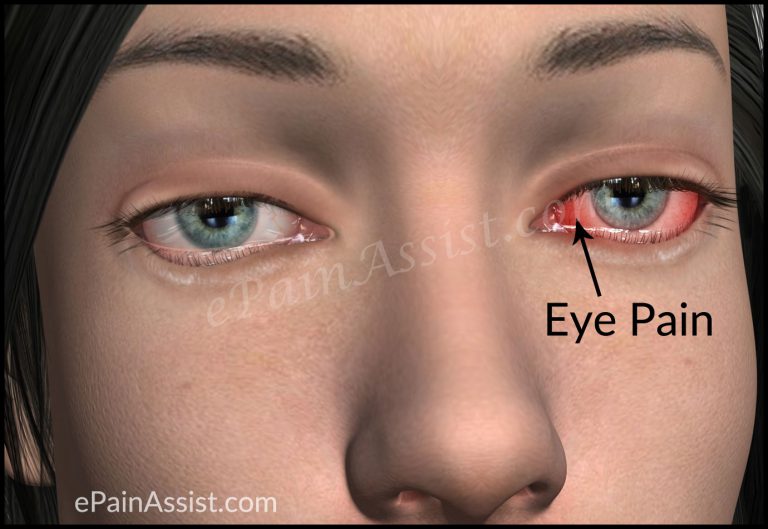 Eye Pain : Types, Causes, Signs, Eye Examination, Treatment, Preventive Steps