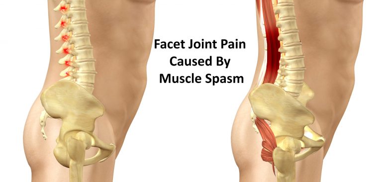 Facet Joint or Zygapophysial Joint Pain: Causes, Symptoms, Treatment