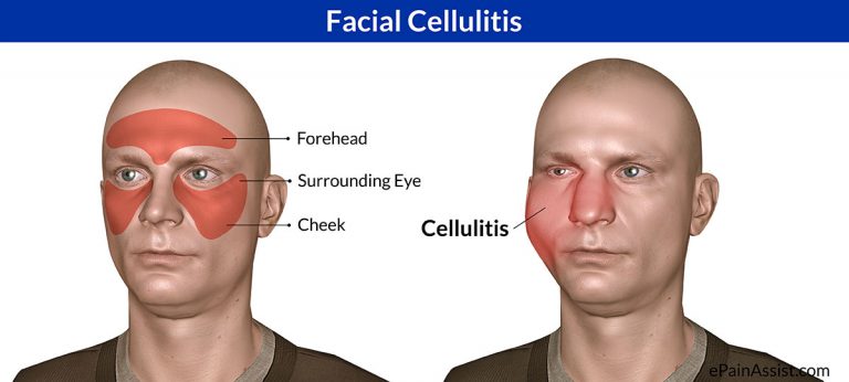 Facial Cellulitis : Causes, Risk Factors, Signs, Symptoms, Investigations, Treatment