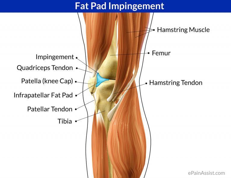 Fat Pad Impingement or Hoffa’s Pad Impingement: Symptoms, Treatment- Ice, TENS Unit