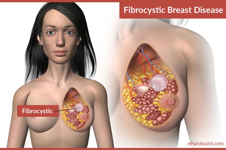 Fibrocystic Breast Disease: Causes, Symptoms, Diagnosis, Treatment, Diet