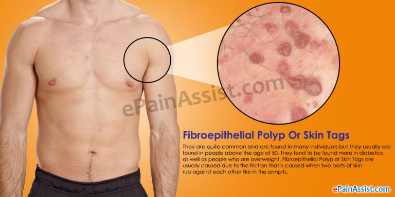 Fibroepithelial Polyp or Skin Tags