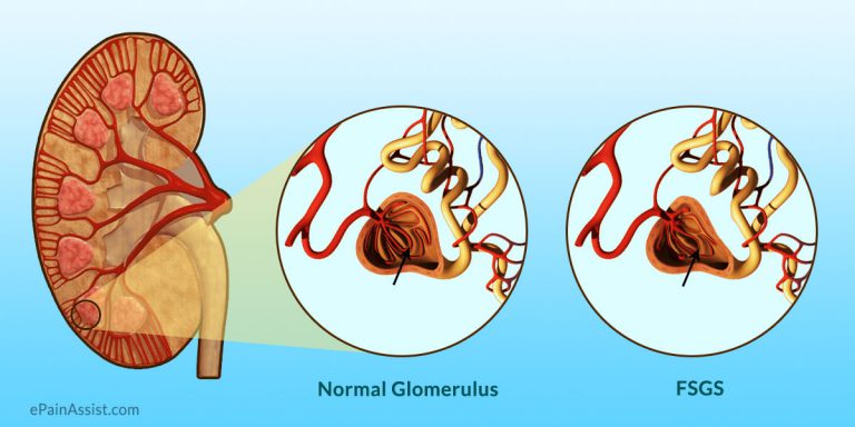 Focal Segmental Glomerulosclerosis (FSGS): Causes, Symptoms, Diagnosis, Treatment