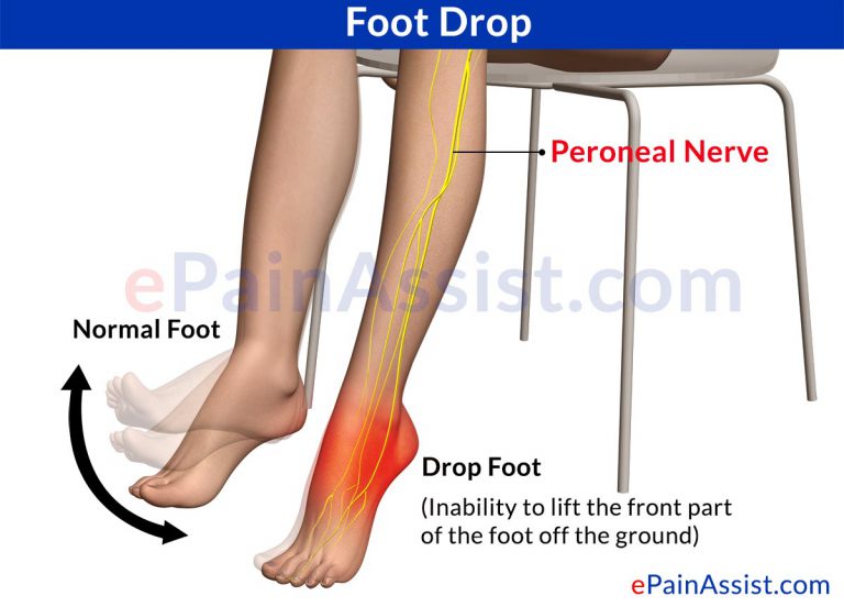 Foot Drop: Symptoms, Treatment, Exercises, Recovery