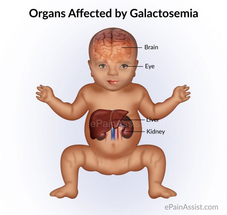 Galactosemia: Causes, Symptoms, Treatment, Prognosis, Complications