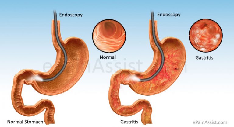 Gastritis: Types, Epidemiology, Causes, Risk Factors, Signs, Symptoms, Treatment