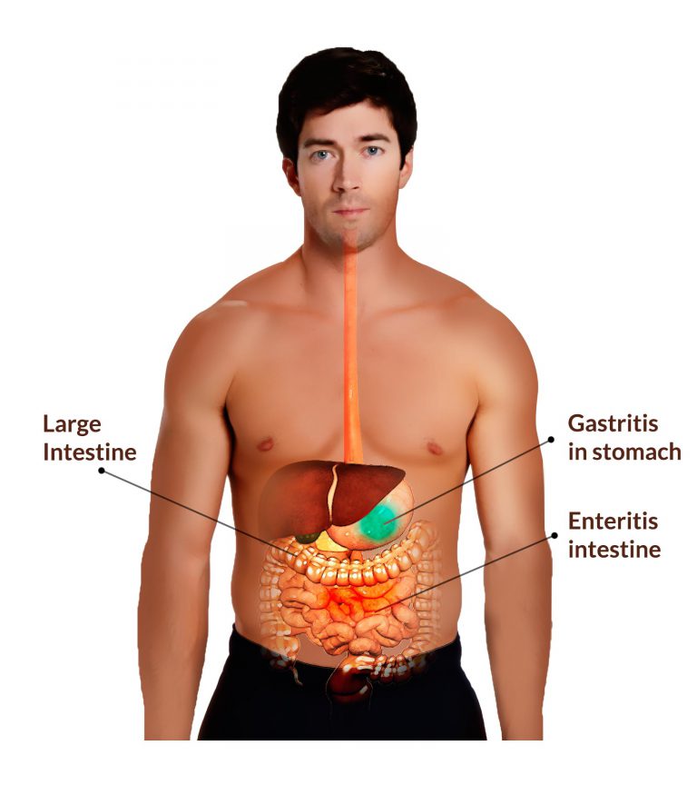 Gastroenteritis or Gastric Flu or Tummy Bug or Gastro: Definition, Types, Epidemiology, Pathophysiology, Causes, Symptoms, Signs, Treatment, Investigations