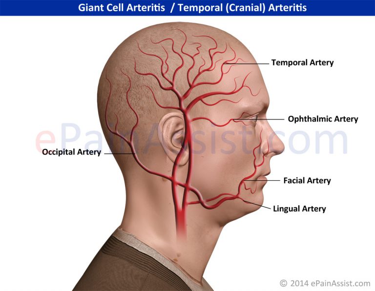 Giant Cell Arteritis: Epidemiology, Causes, Risk Factors, Signs,Symptoms, Treatment, Diagnosis, Prevention