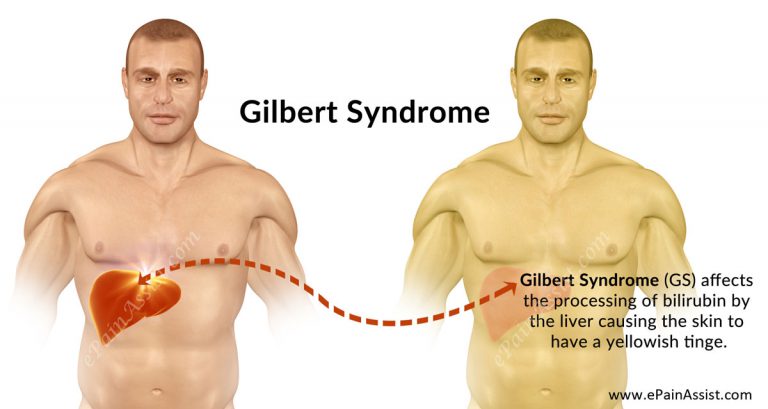 Gilbert Syndrome (GS): Definition, Causes, Symptoms, Diagnosis, Treatment