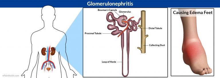 Glomerulonephritis or Glomerular Nephritis: Causes, Symptoms, Diagnosis, Treatment