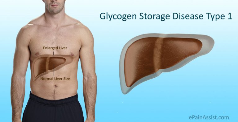 Glycogen Storage Disease Type 1 (GSD 1) or Von Gierke’s Disease: Definition, Causes, Symptoms, Diagnosis, Treatment