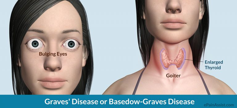 Graves’ Disease or Basedow-Graves Disease: Causes, Symptoms, Ophthalmopathy, Dermopathy