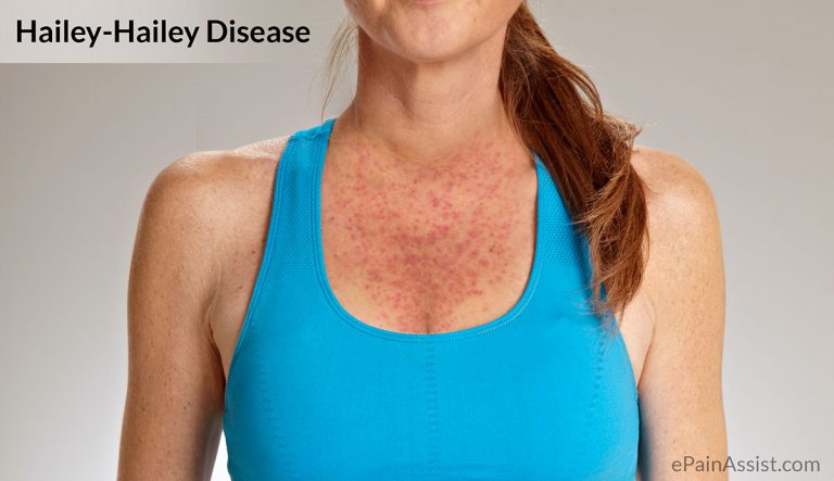 Hailey-Hailey Disease or Familial Benign Pemphigus: Causes, Treatment, Home Remedies