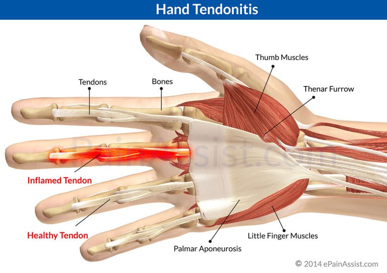 Hand Tendonitis: Causes, Risk Factors, Symptoms, Treatment