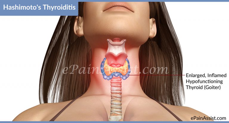 Hashimoto’s Disease or Hashimoto’s Thyroiditis: Causes, Risk Factors, Symptoms, Treatment