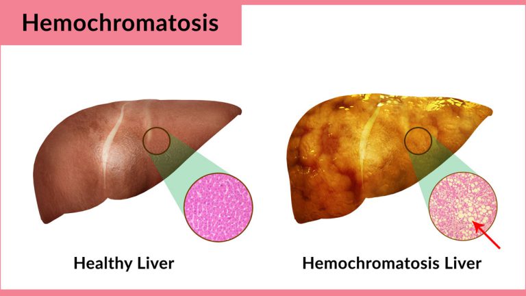 Hemochromatosis or Iron Overload: Facts, Causes, Risk Factors, Symptoms, Treatment