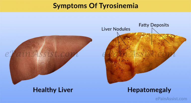 Tyrosinemia: Causes, Symptoms, Diagnosis, Treatment