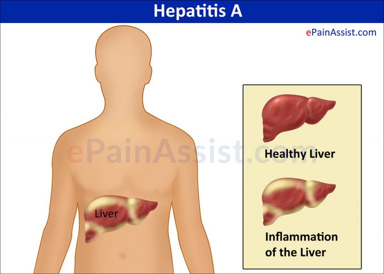 Hepatitis A: Signs, Symptoms, Diagnosis, Prevention, Treatment, Prognosis