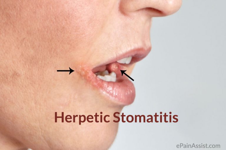 Herpetic Stomatitis : Causes, Signs, Symptoms, Diagnosis, Treatment, Prevention