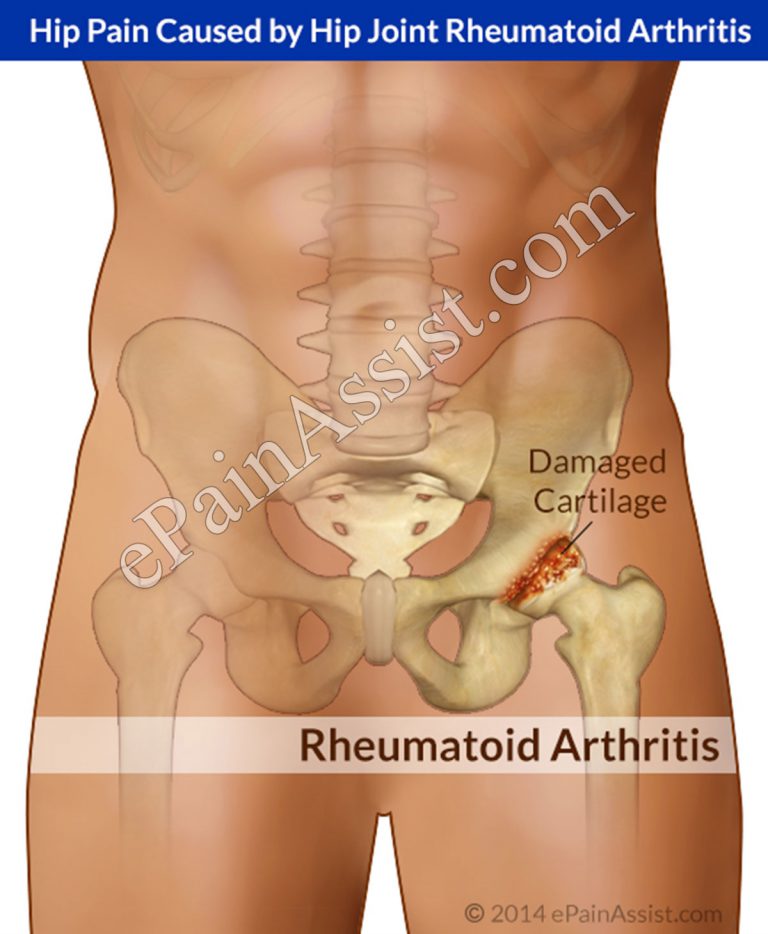 Hip Joint Rheumatoid Arthritis: Causes, Signs, Symptoms, Treatment
