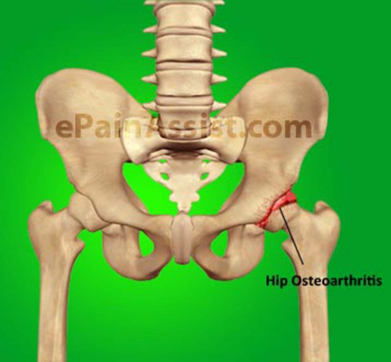 Hip Joint Osteoarthritis: Causes, Symptoms, Diagnosis, Treatment