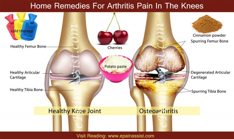 Home Remedies For Arthritis Pain In The Knees