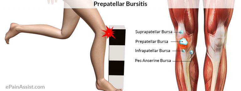 Prepatellar Bursitis or Beat Knee or Carpet Layer’s Knee: Signs, Causes, Treatment