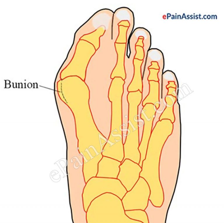 Bunions or Hallux Valgus Deformity: Symptoms, Causes, Treatment- Bunion Splint