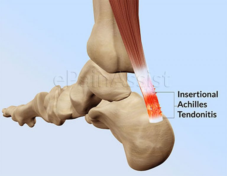 Insertional Achilles Tendonitis: Causes, Symptoms, Treatment, Recovery Time, Exercises