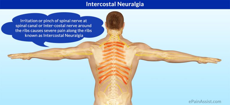 What Is Intercostal Neuralgia: Symptoms, Causes, Treatment, Pathophysiology, Diagnosis
