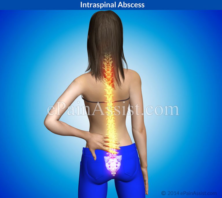 Intraspinal Abscess: Causes, Symptoms, Diagnosis, Treatment- Intravenous Antibiotics